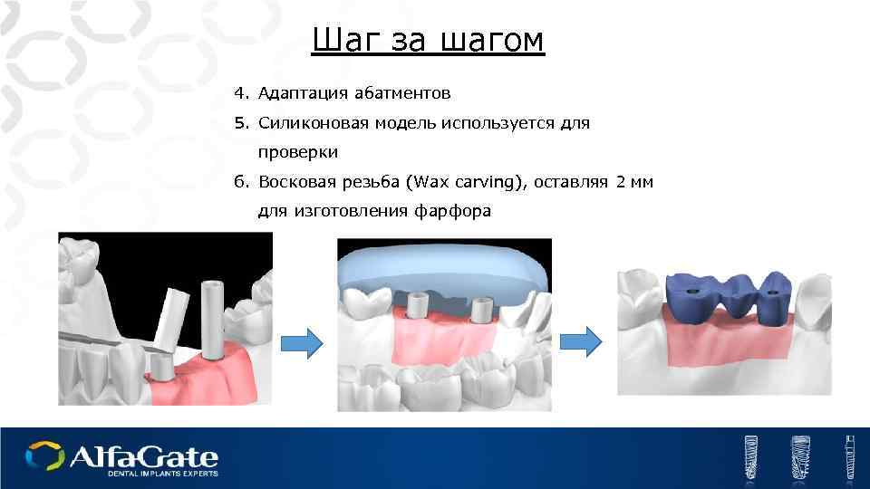 Шаг за шагом 4. Адаптация абатментов 5. Силиконовая модель используется для проверки 6. Восковая