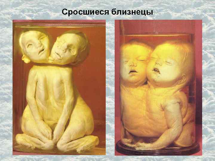 Сросшиеся близнецы 