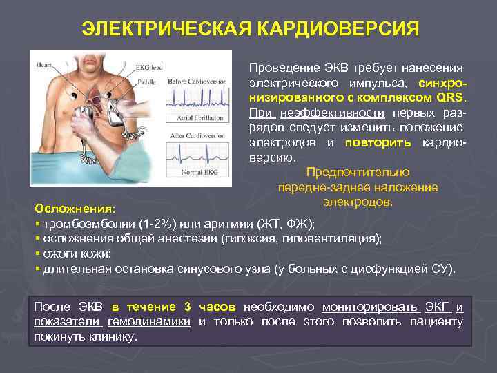 ЭЛЕКТРИЧЕСКАЯ КАРДИОВЕРСИЯ Проведение ЭКВ требует нанесения электрического импульса, синхронизированного с комплексом QRS. При неэффективности