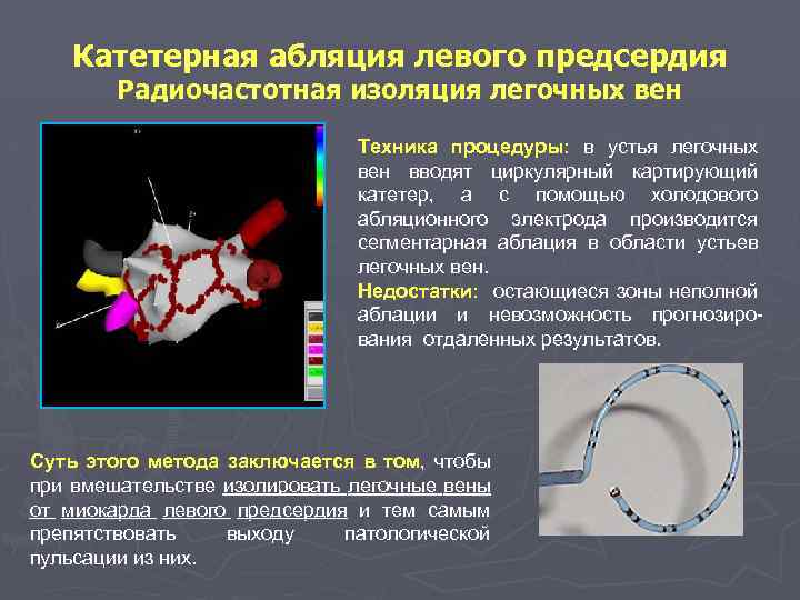 Катетерная абляция левого предсердия Радиочастотная изоляция легочных вен Техника процедуры: в устья легочных вен