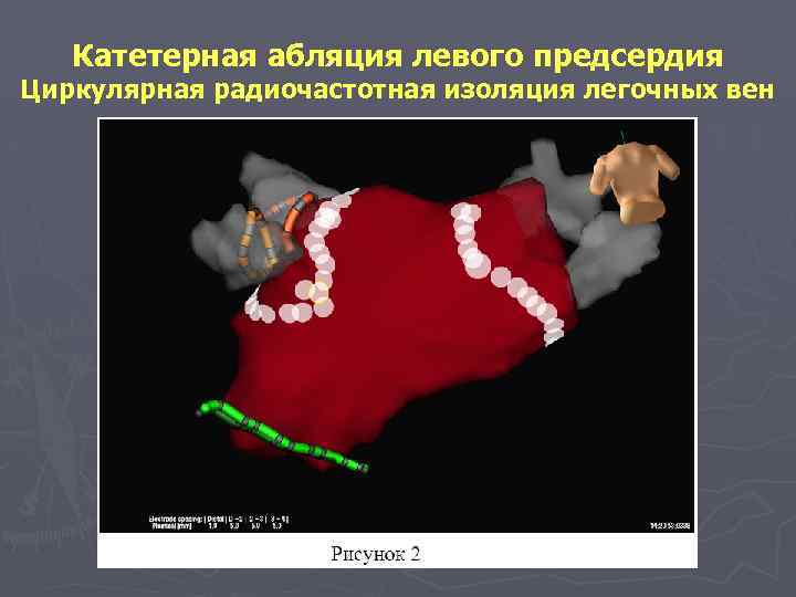 Катетерная абляция левого предсердия Циркулярная радиочастотная изоляция легочных вен 