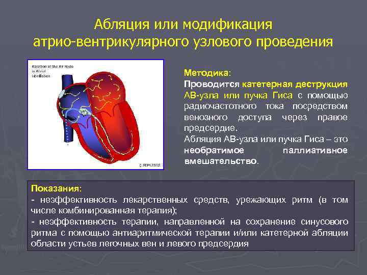 Абляция или модификация атрио-вентрикулярного узлового проведения Методика: Проводится катетерная деструкция АВ-узла или пучка Гиса