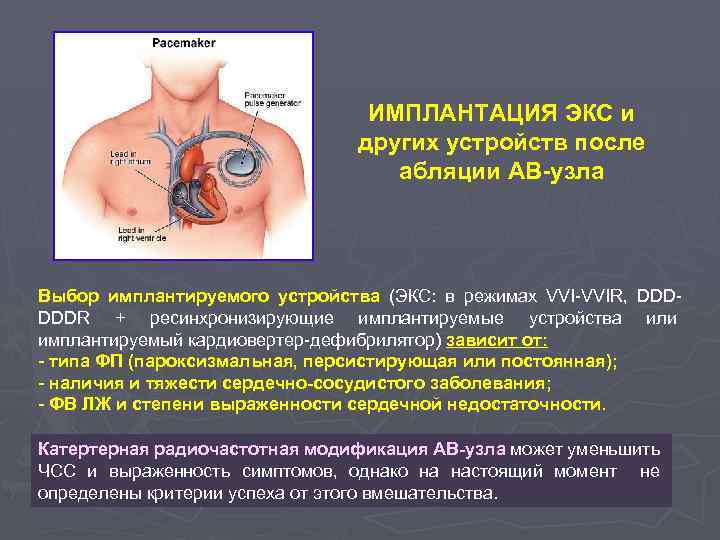 ИМПЛАНТАЦИЯ ЭКС и других устройств после абляции АВ-узла Выбор имплантируемого устройства (ЭКС: в режимах
