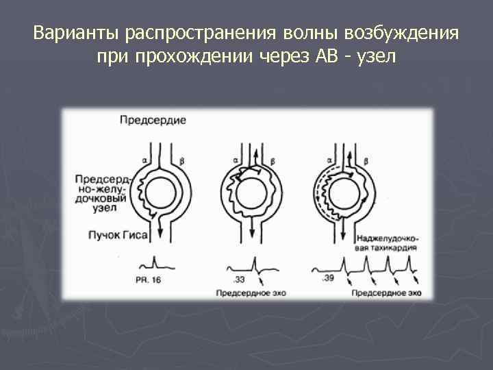 Варианты распространения волны возбуждения при прохождении через АВ - узел 