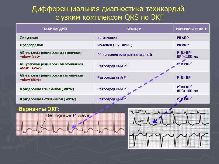 Дифференциальная диагностика тахикардий с узким комплексом QRS по ЭКГ ТАХИКАРДИЯ ЗУБЕЦ Р Располо-жение Р