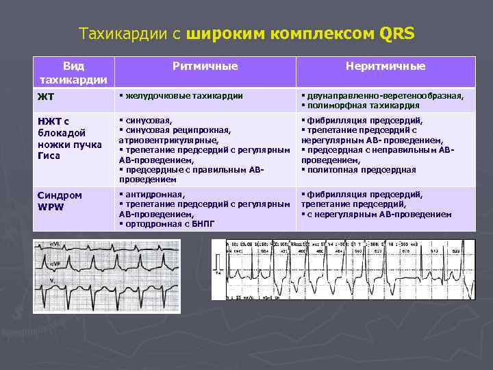 Тахикардии с широким комплексом QRS Вид тахикардии Ритмичные Неритмичные ЖТ § желудочковые тахикардии §