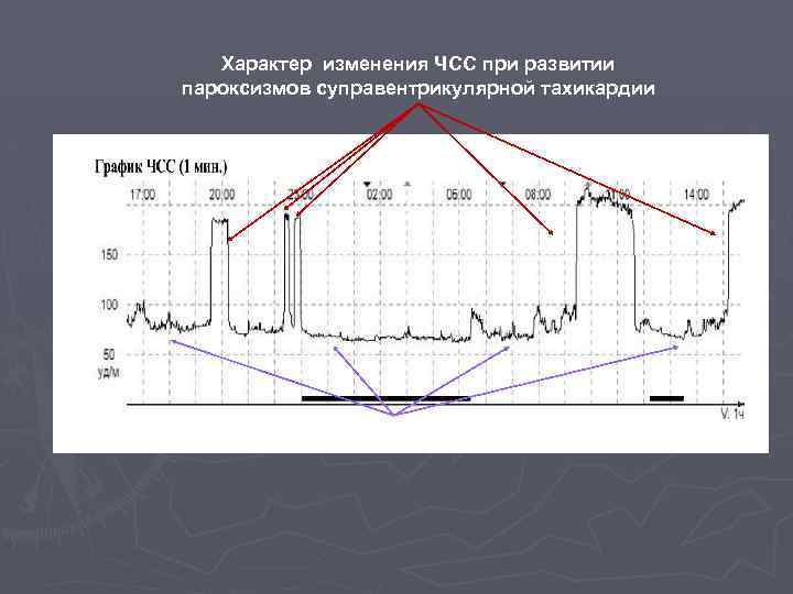 Характер изменения ЧСС при развитии пароксизмов суправентрикулярной тахикардии Синусовый ритм 