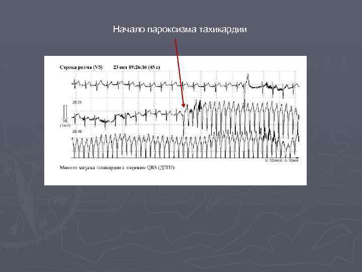 Начало пароксизма тахикардии ЭС ЭС 