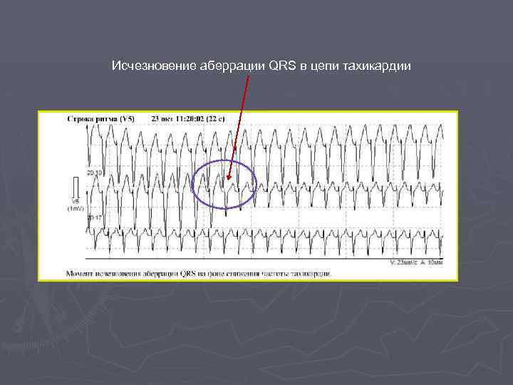 Исчезновение аберрации QRS в цепи тахикардии ? 