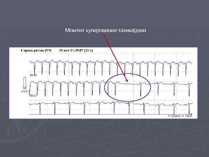 Момент купирования тахикардии 