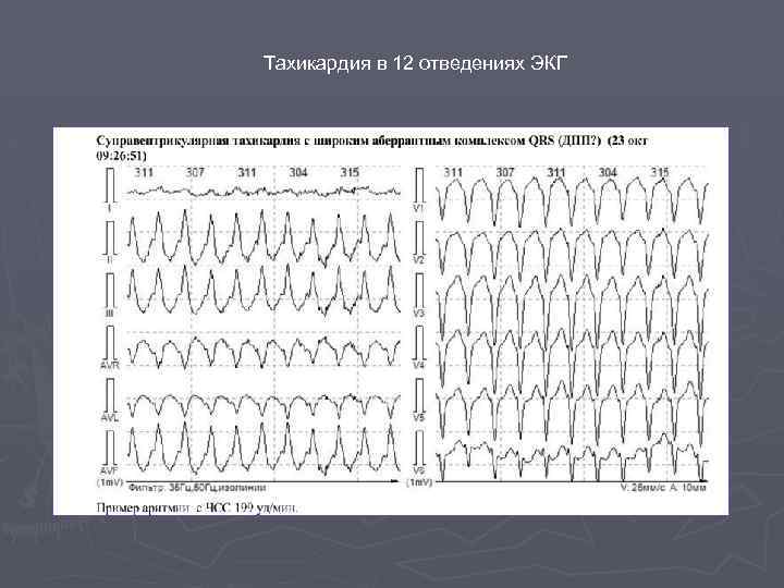 Тахикардия в 12 отведениях ЭКГ 