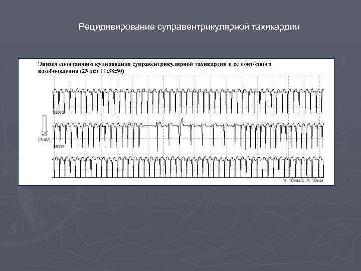 Рецидивирование суправентрикулярной тахикардии 