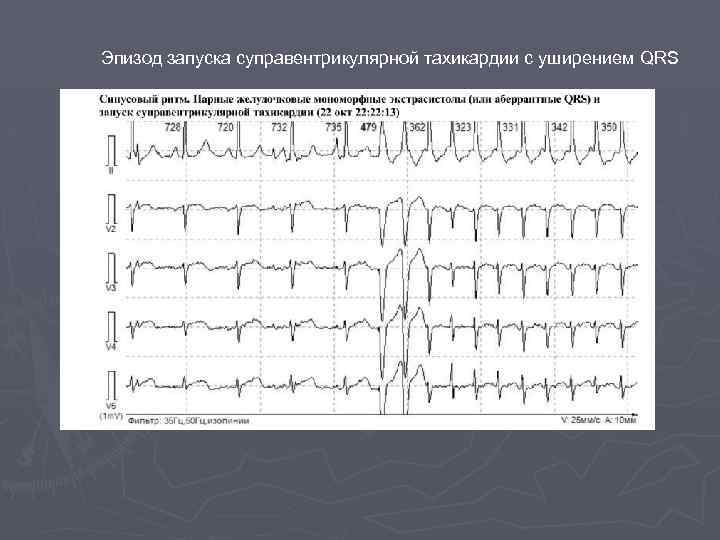 Эпизод запуска суправентрикулярной тахикардии с уширением QRS 