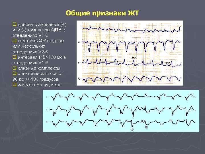 Общие признаки ЖТ q однонаправленные (+) или (-) комплексы QRS в отведениях V 1