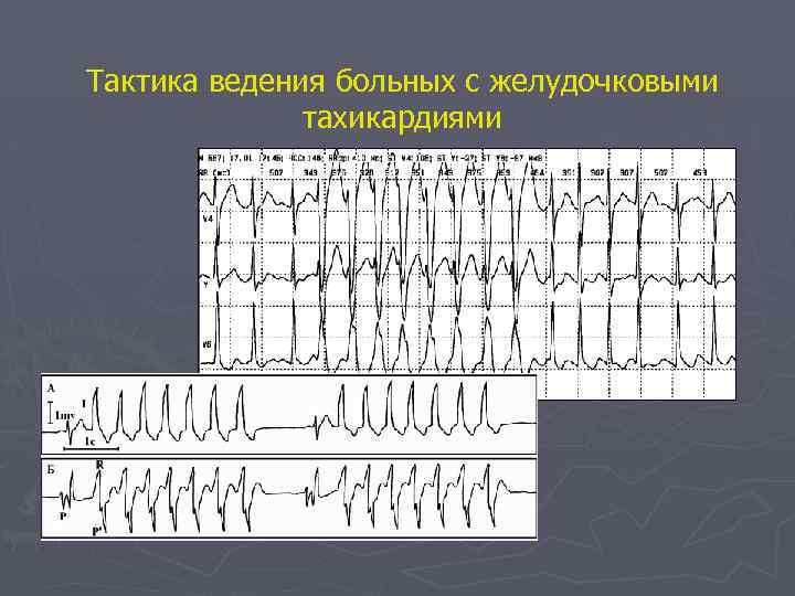 Тактика ведения больных с желудочковыми тахикардиями 