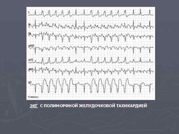 ЭКГ С ПОЛИМОРФНОЙ ЖЕЛУДОЧКОВОЙ ТАХИКАРДИЕЙ 
