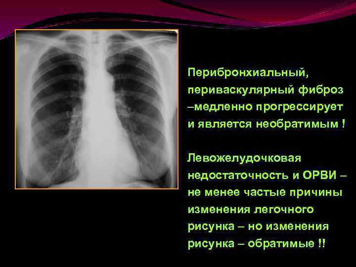 Фиброз легких что это такое. Фиброз легкого рентген. Перибронхиальные изменения в легких что это. Перибронхиальный фиброз. Перибронхиальные и периваскулярные изменения в легких что это.