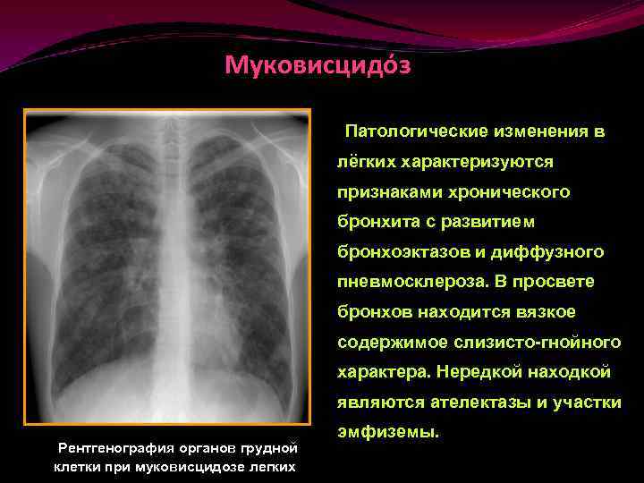 Пневмосклероз это простыми словами. Рентген хронический бронхит пневмосклероз. Хронический обструктивный бронхит рентген. Пневмосклероз рентген описание. Диффузный пневмосклероз рентген.