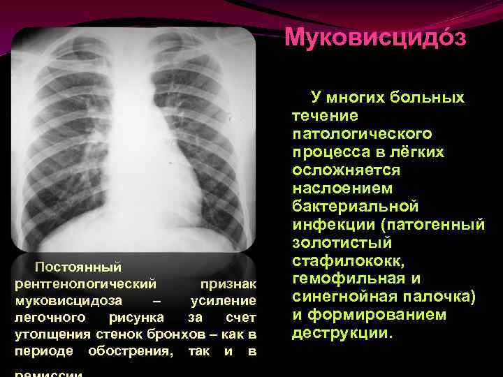 Усиление деформация легочного рисунка что это на рентгене