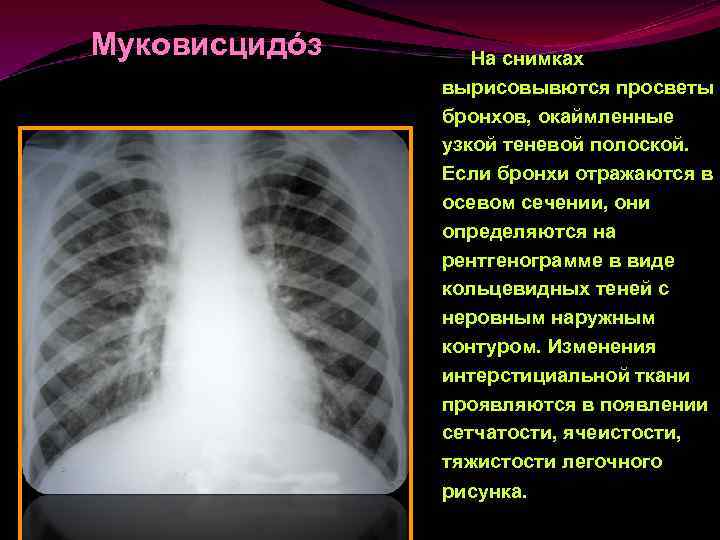 Муковисцидóз На снимках вырисовывются просветы бронхов, окаймленные узкой теневой полоской. Если бронхи отражаются в