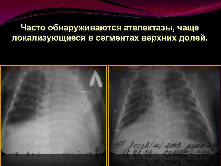 Часто обнаруживаются ателектазы, чаще локализующиеся в сегментах верхних долей. 
