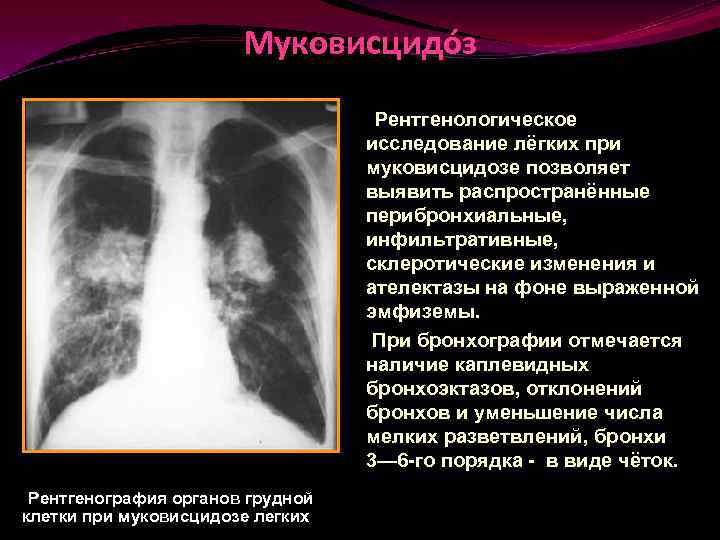 Функциональные изменения в легких. Перибронхиальный фиброз рентген. Рентгенологическое исследование лёгких. Кт легких при муковисцидозе. Муковисцидоз рентген легких.