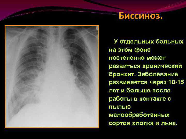 Биссиноз. У отдельных больных на этом фоне постепенно может развиться хронический бронхит. Заболевание развивается