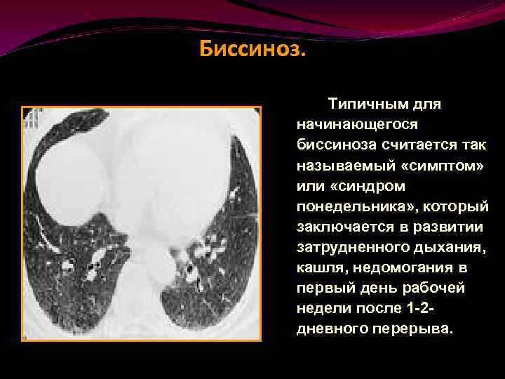 Биссиноз. Типичным для начинающегося биссиноза считается так называемый «симптом» или «синдром понедельника» , который