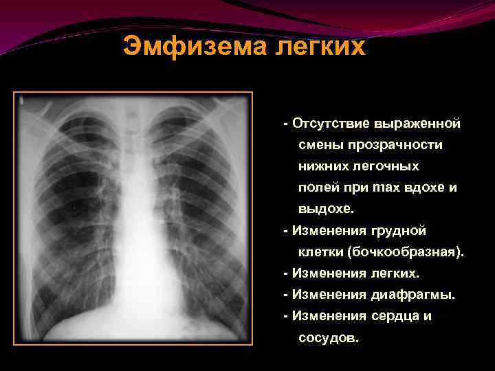 Поле легкого. Бочкообразная грудная клетка эмфизема. Изменение грудной клетки при эмфиземе легких. Эмфизема грудной клетки рентген. Повышение прозрачности легочных полей.