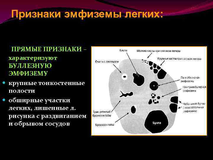 Центрилобулярная эмфизема легких