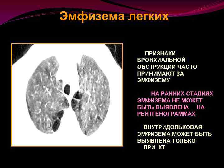 Презентация на тему эмфизема легких - 98 фото