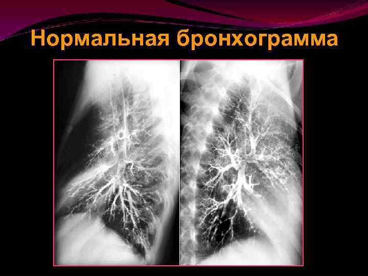 Нормальная бронхограмма 