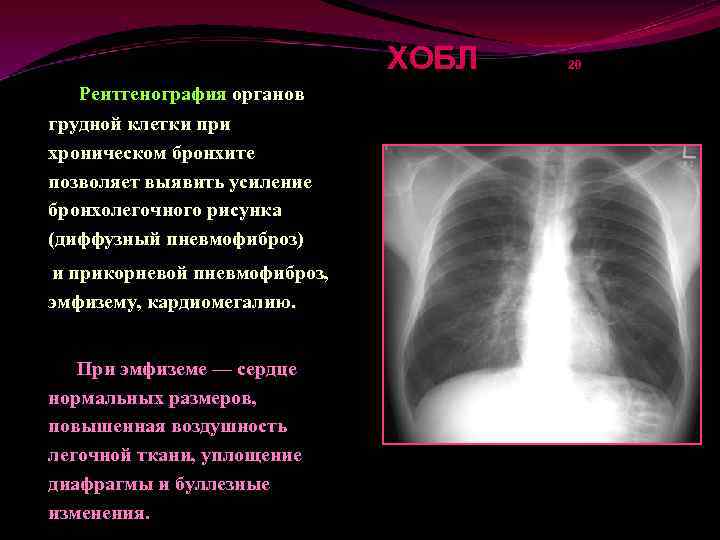 Рентгенологическая картина при хобл