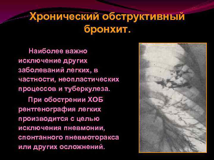 Хронический обструктивный бронхит. Наиболее важно исключение других заболеваний легких, в частности, неопластических процессов и