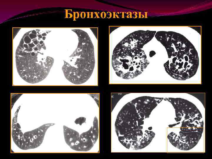 Бронхоэктазы в легких что это