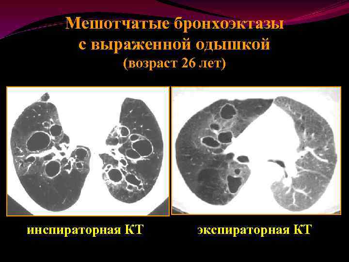 Кт картина бронхоэктазов