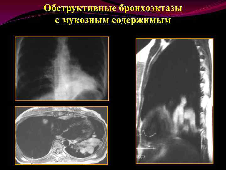 Обструктивные бронхоэктазы с мукозным содержимым 