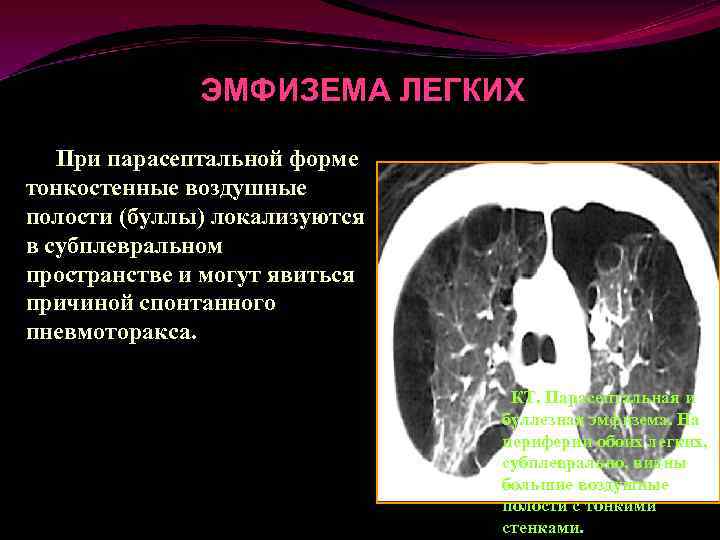 Полость заболевания легких. Парасептальная буллезная эмфизема. Буллезная эмфизема легких кт. Эмфизема легкого кт парасептальная.