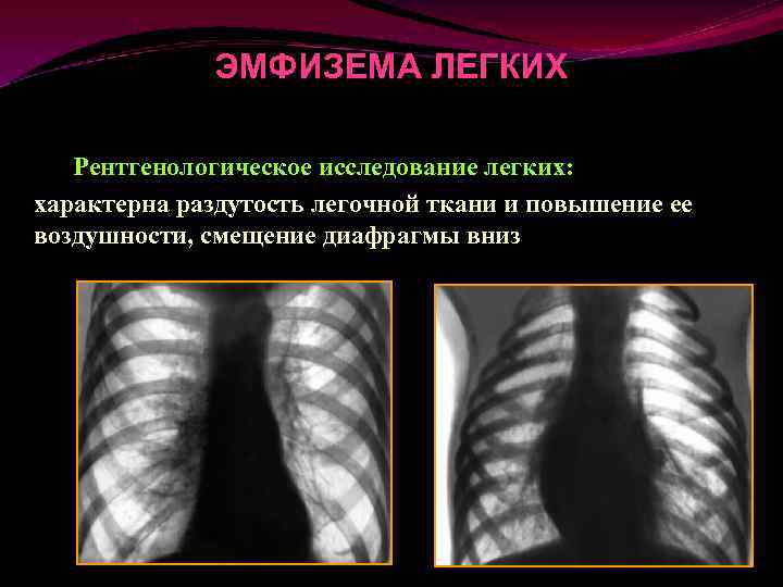 Обеднение сосудистого рисунка легких характерно для