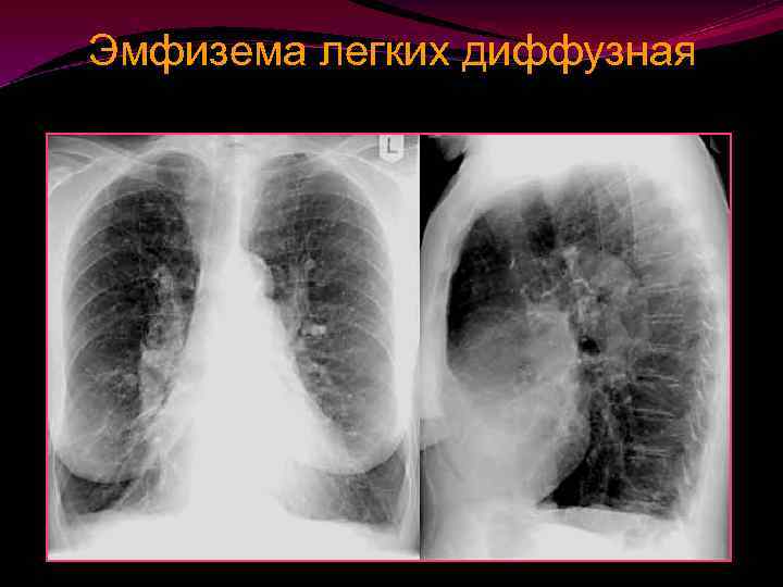 Эмфизема легких. Хроническая эмфизема легких рентген. Хроническая очаговая эмфизема. Рентген при ХОБЛ эмфизема. Обструктивная эмфизема рентген.