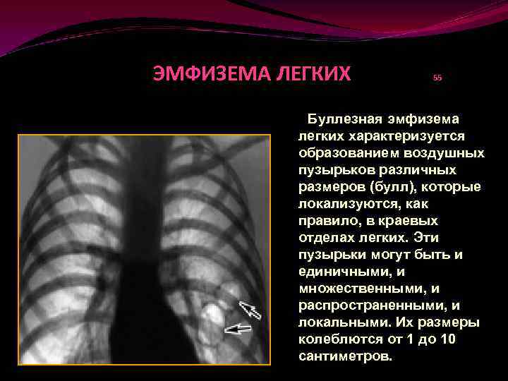 Полость заболевания легких. Заболевание легких эмфизема. Перифокальная эмфизема. Заболевание буллезная эмфизема.