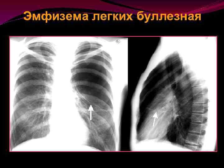 Эмфизема легких буллезная 