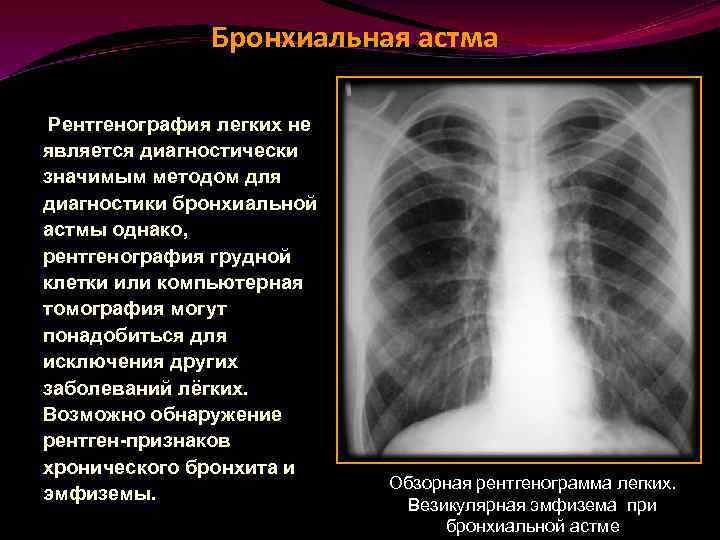 После флюорография можно можно кт делать. Признаки астмы на рентгене. Рентгенограмма органов грудной клетки при бронхиальной астме. Рентгенограмма грудной клетки при бронхиальной астме. Снимки рентгена легких при астме.