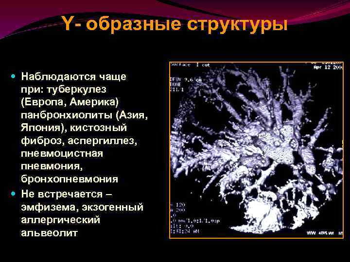 Y- образные структуры Наблюдаются чаще при: туберкулез (Европа, Америка) панбронхиолиты (Азия, Япония), кистозный фиброз,