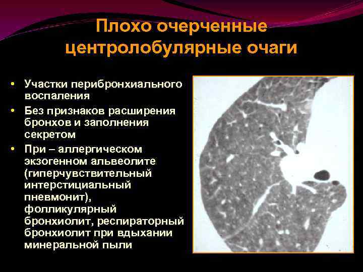 Гиперчувствительный пневмонит презентация - 85 фото