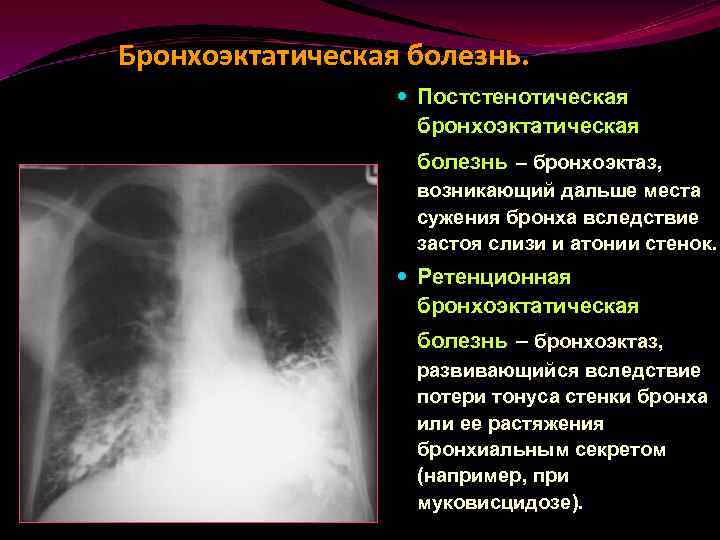 Бронхоэктатическая болезнь. Бронхоэктатическая болезнь рентген описание. Рентген бронхоэктатической болезни. Бронхоэктатической болезни рентгенография легких. Рентгенография легких при бронхоэктатической болезни.