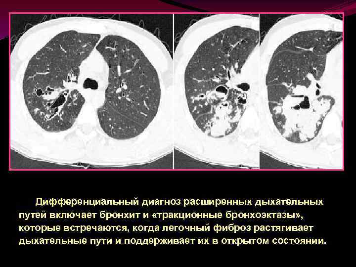 Кт картина бронхоэктазов