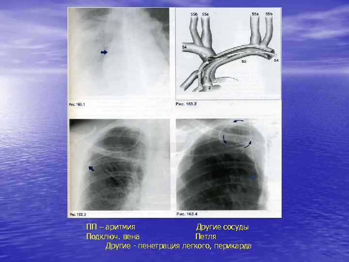 ПП – аритмия Другие сосуды Подключ. вена Петля Другие - пенетрация легкого, перикарда 
