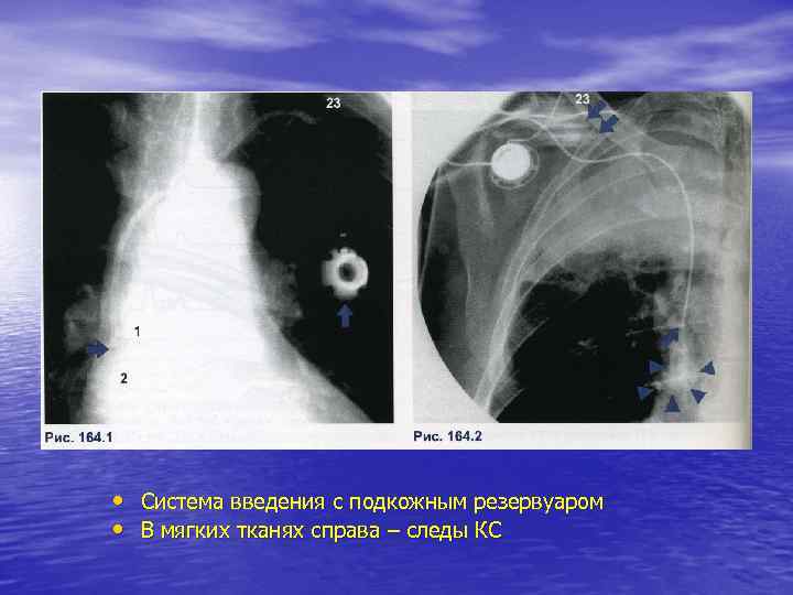  • Система введения с подкожным резервуаром • В мягких тканях справа – следы