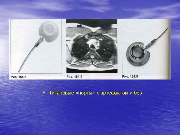  • Титановые «порты» с артефактом и без 
